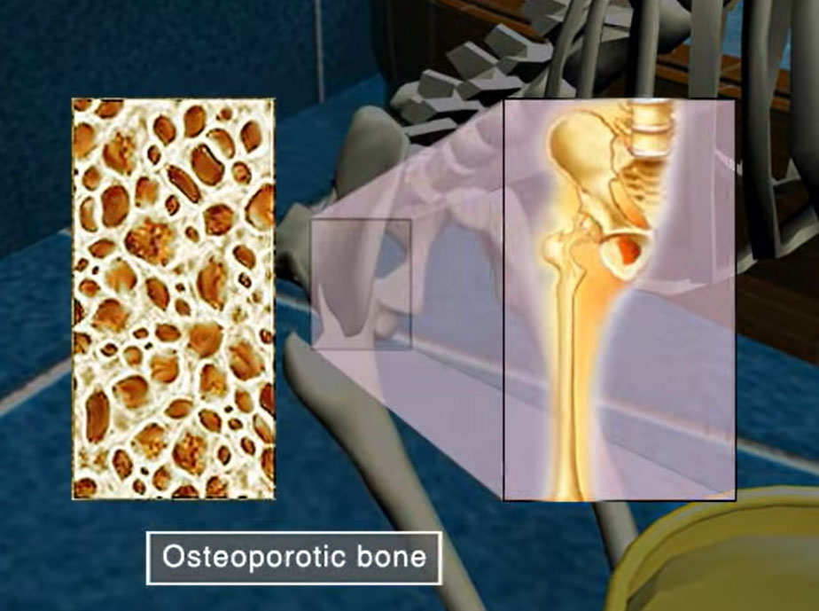 osteoporose