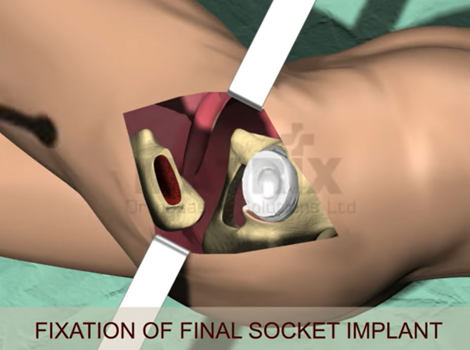 artroplastia quadril